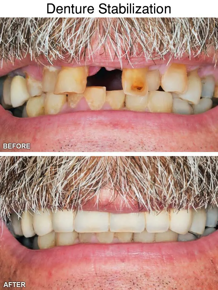 Denture Stabilization