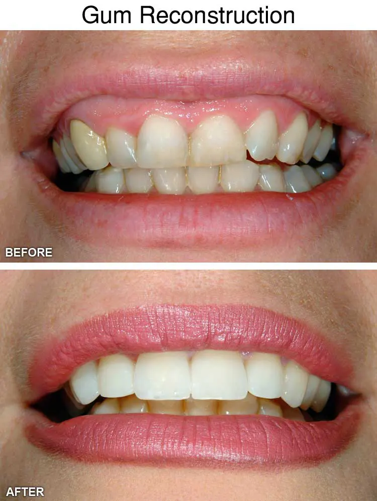 Gum Reconstruction