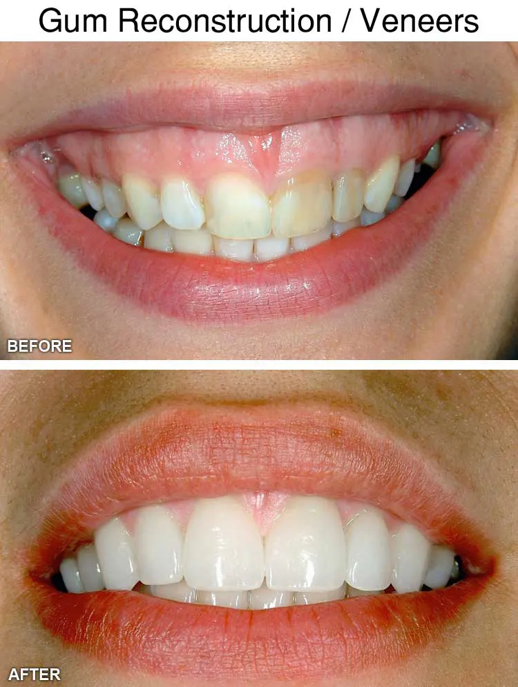 Gum Reconstruction Veneers