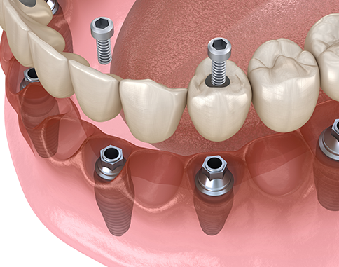 All-on-4 Implant Dentures