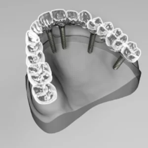 Types of Insurance Covering Dental Implants