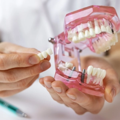Are Dental Implants Covered by Insurance?